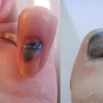 Як вилікувати почорніння нігтів після травми?