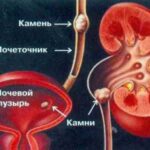 Лікування народними засобами сечокам’яної хвороби
