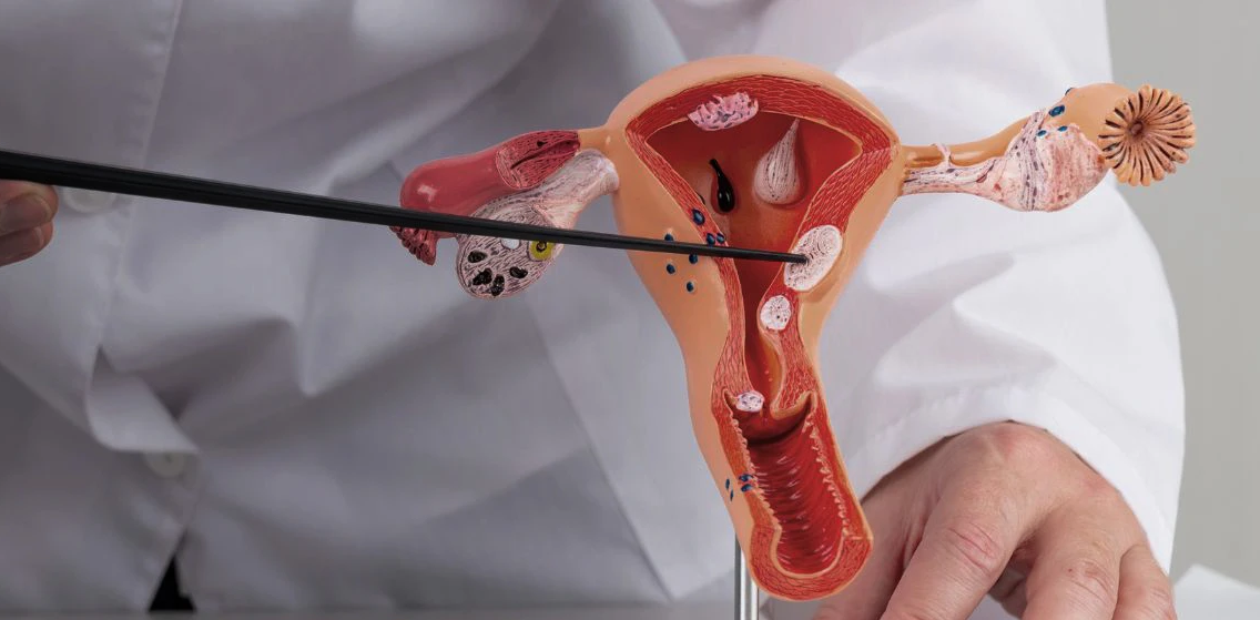 ВООЗ б'є на сполох: 660 тисяч жінок щорічно вражає рак шийки матки – де найгірша ситуація? 2