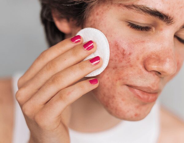 Найкращі та найгірші продукти для шкіри: як харчування впливає на&hellip;