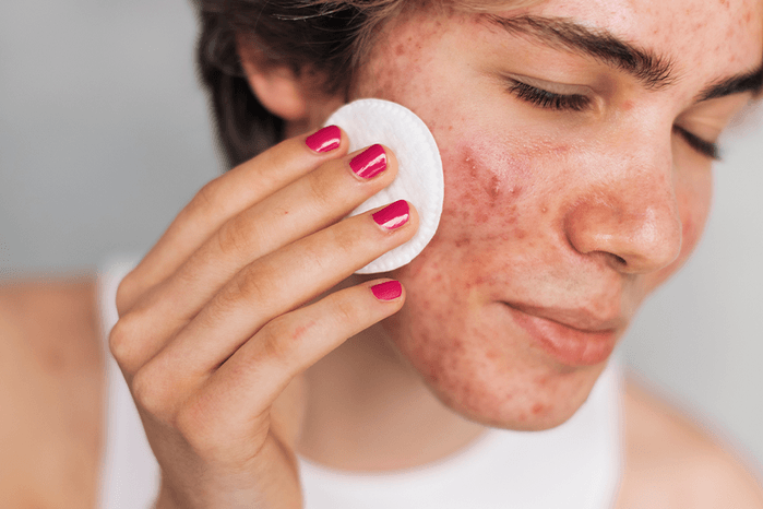 Найкращі та найгірші продукти для шкіри: як харчування впливає на акне