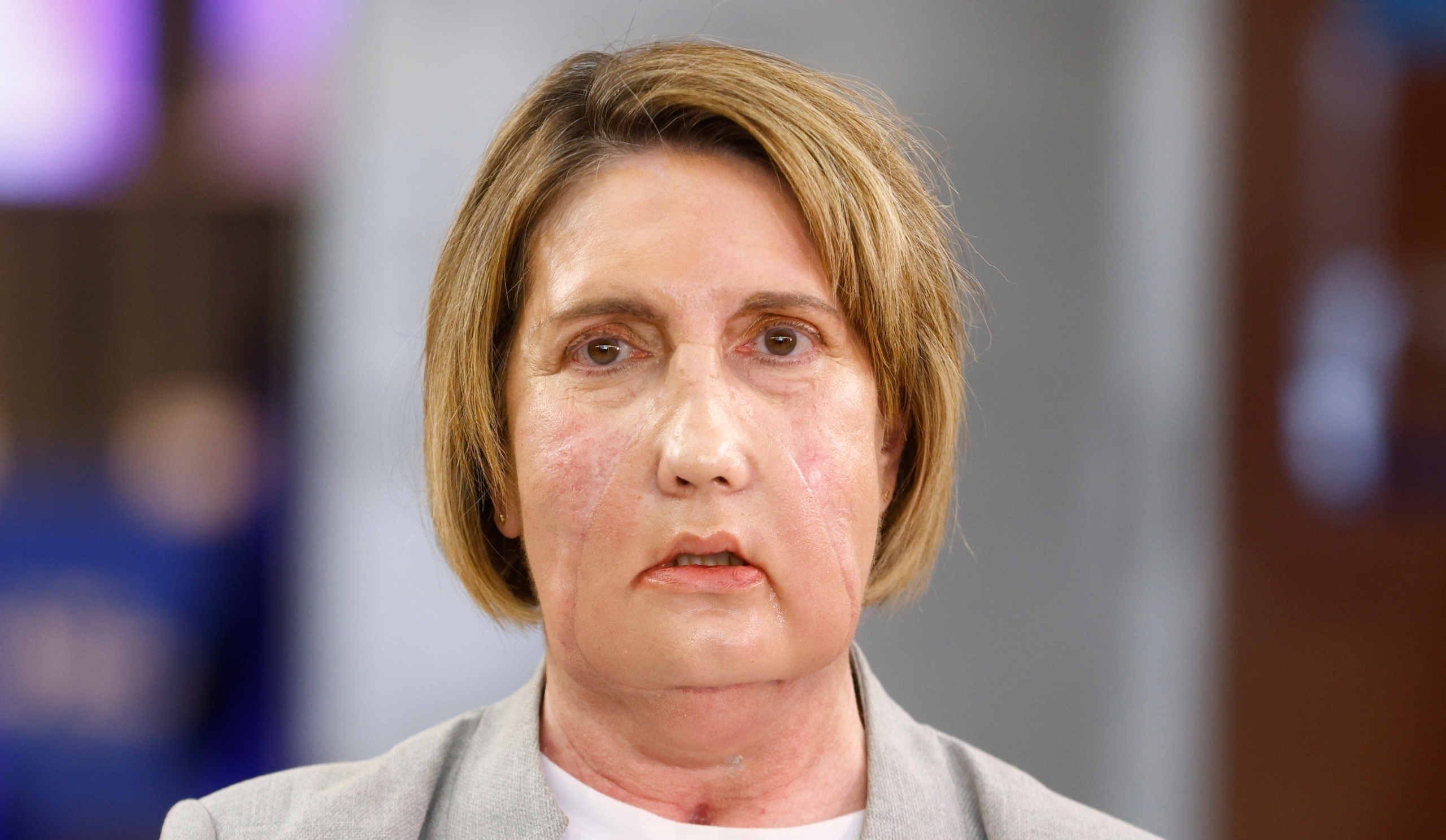 Барселона: Революційна трансплантація обличчя від донорки, яка обрала шлях асистованої смерті 4