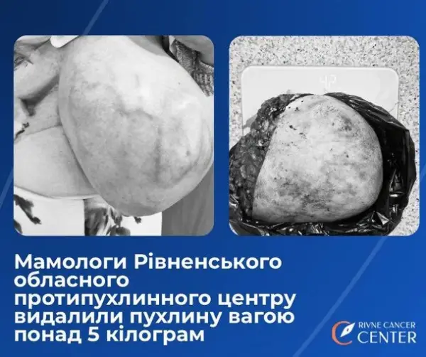 У Рівному жінці видалили пухлину розміром із плід 4