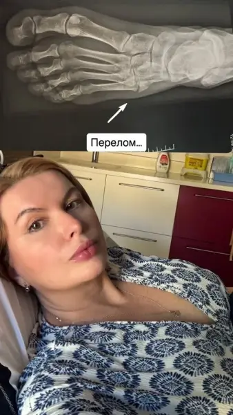 Ведуча Наталка Карпа перенесла складну операцію після травми руки 4